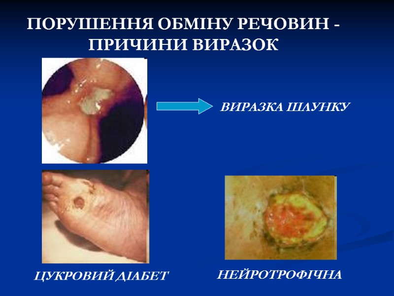 ПОРУШЕННЯ ОБМІНУ РЕЧОВИН - ПРИЧИНИ ВИРАЗОК ВИРАЗКА ШЛУНКУ ЦУКРОВИЙ ДІАБЕТ НЕЙРОТРОФІЧНА ПОРУШЕННЯ ОБМІНУ РЕЧОВИН - ПРИЧИНИ ВИРАЗОК ВИРАЗКА ШЛУНКУ ЦУКРОВИЙ ДІАБЕТ НЕЙРОТРОФІЧНА